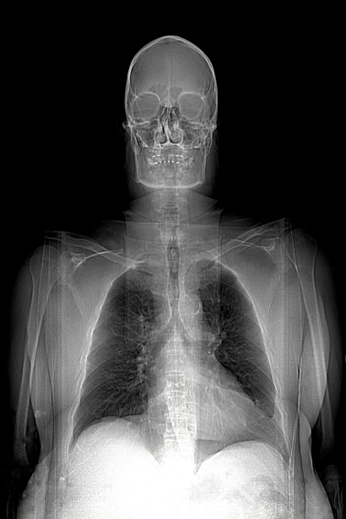 MRI (Magnetic Resonance Image) of a man, showing the head, shoulders, lungs,thoracic cavity, arms, and heart.