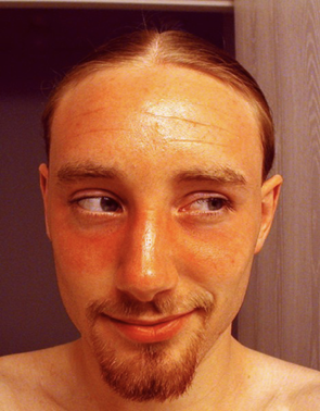 Photo of a man with a sunburn